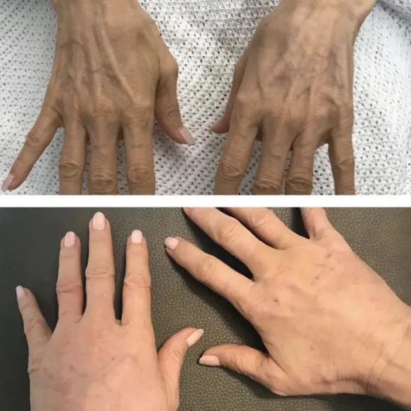 Micro-Transplants