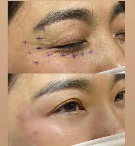 Injectables & Mesotherapy